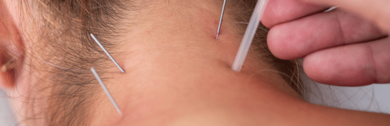 A physical therapist performs dry needling on a patients neck to alleviate muscle tension.