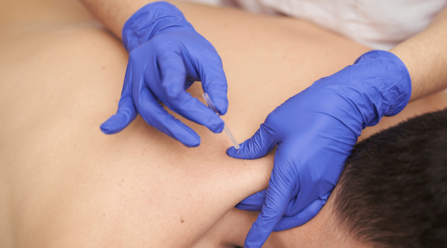 physiotherapist treating an overload with dry needling