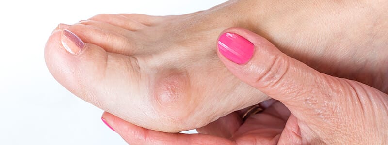 Bunion