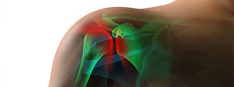 Rotator Cuff Injury